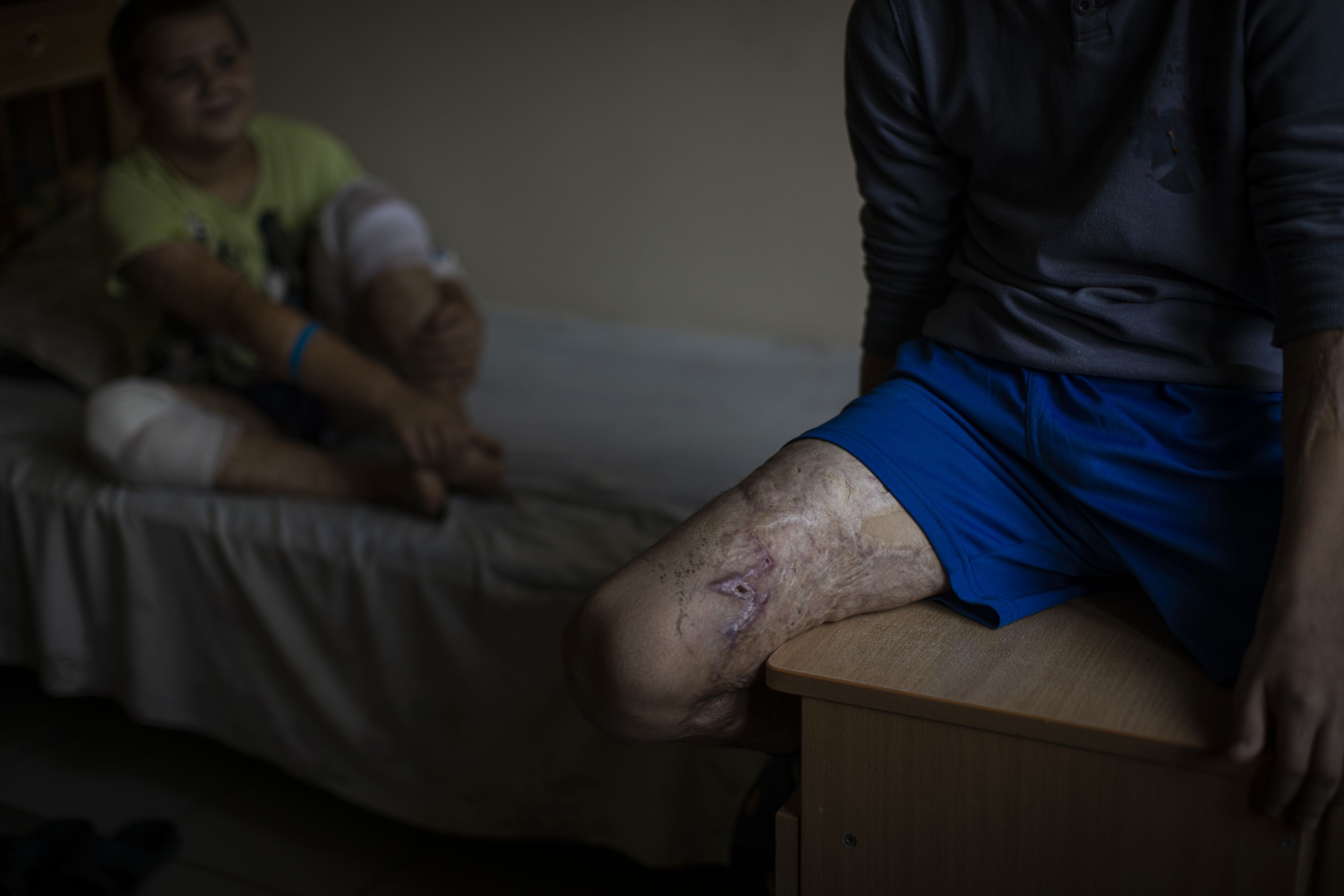 A boy sits on a bed and shows his leg, which was injured during bombing in Ukraine.