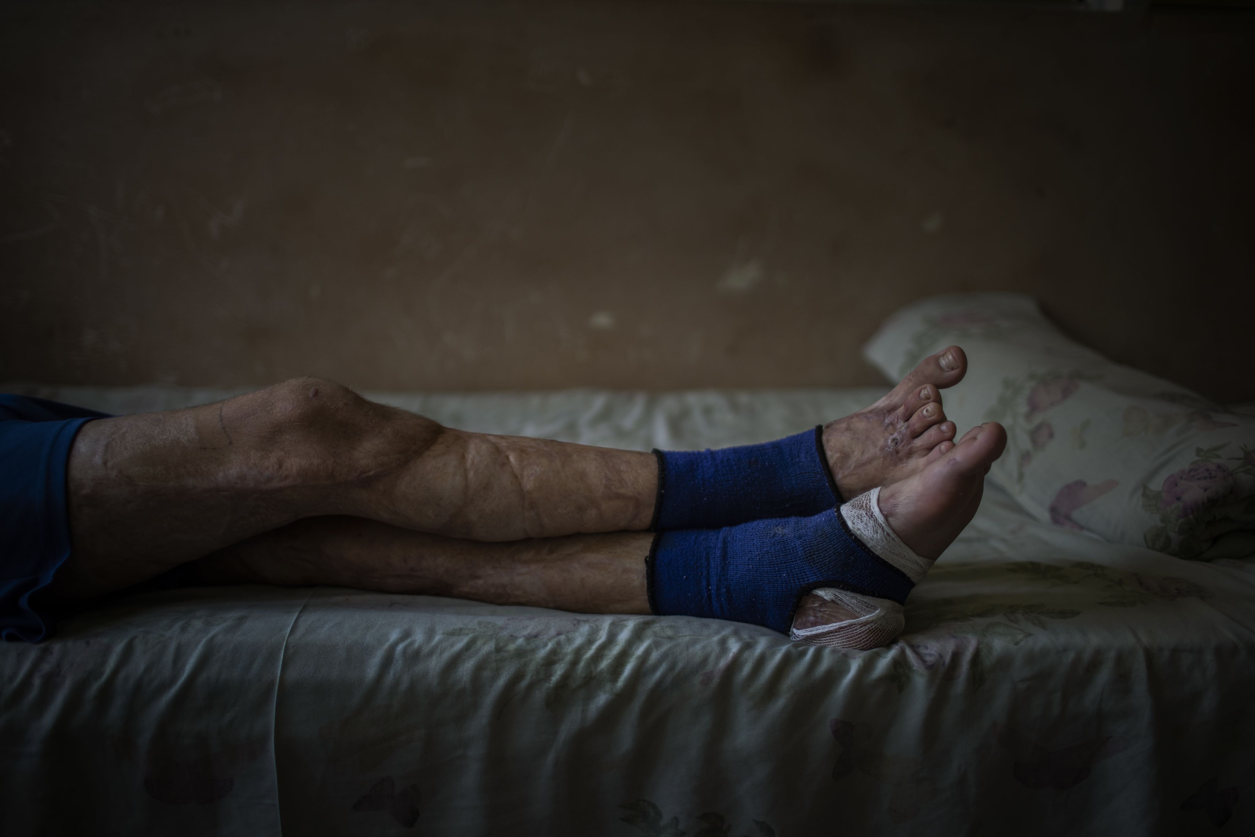 The injuries to Mykhailo's legs are pictured as he lays on the bed in a hospital.
